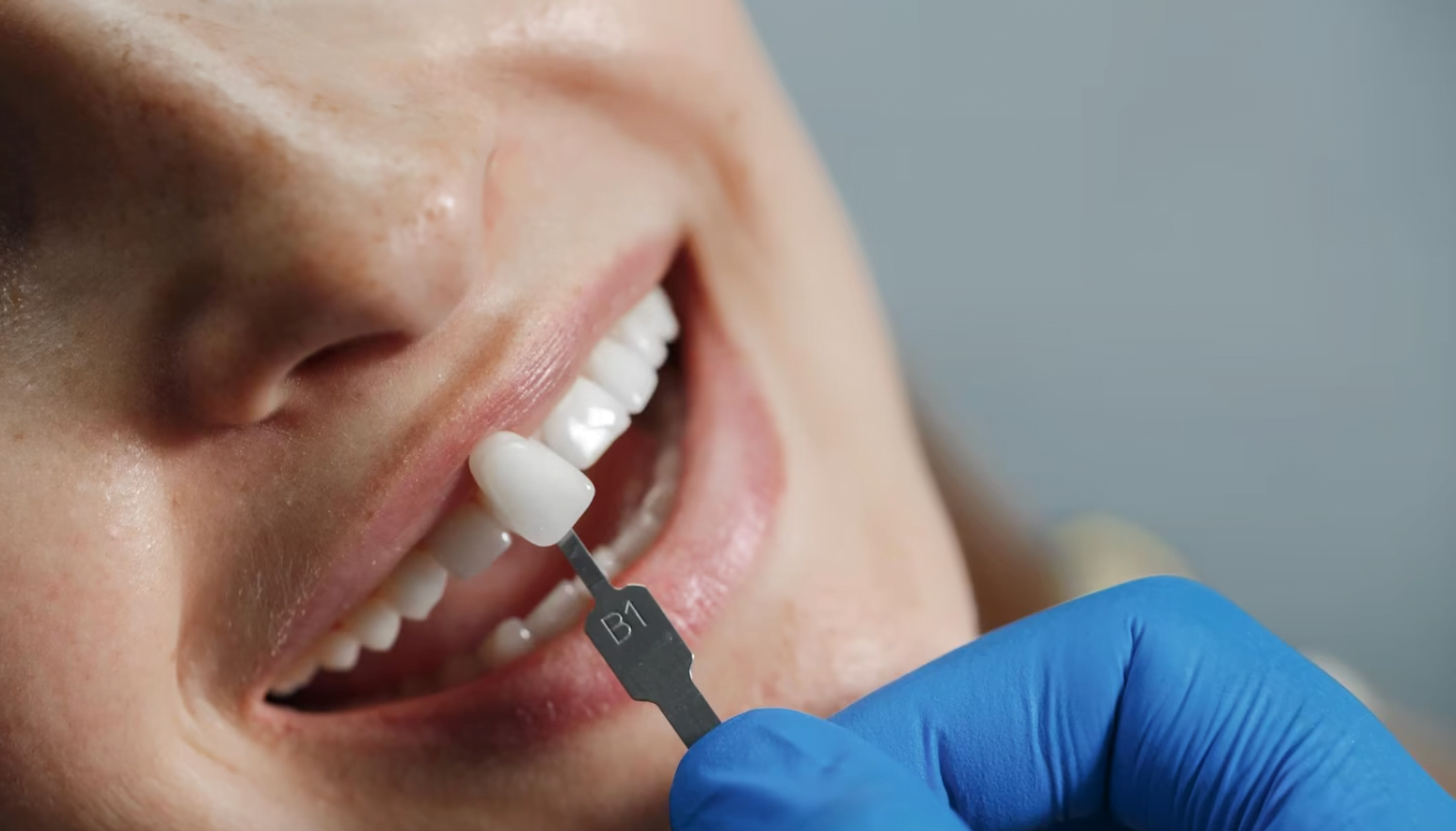 Veneer planning before treatment at Dental Select Pattaya