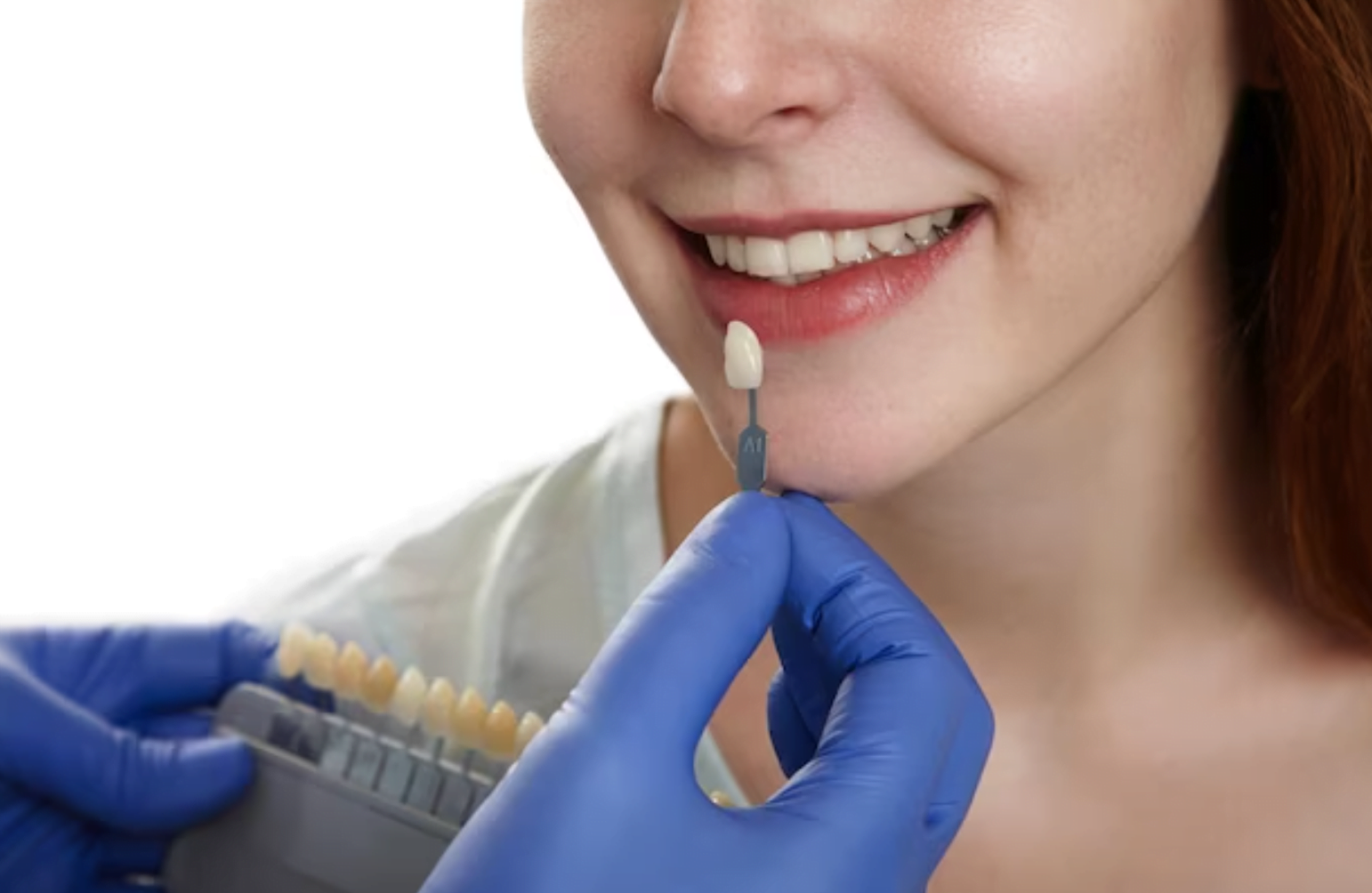 Veneer smile makeover result at Dental Select Pattaya