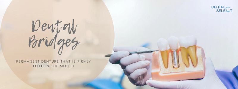 dental bridge