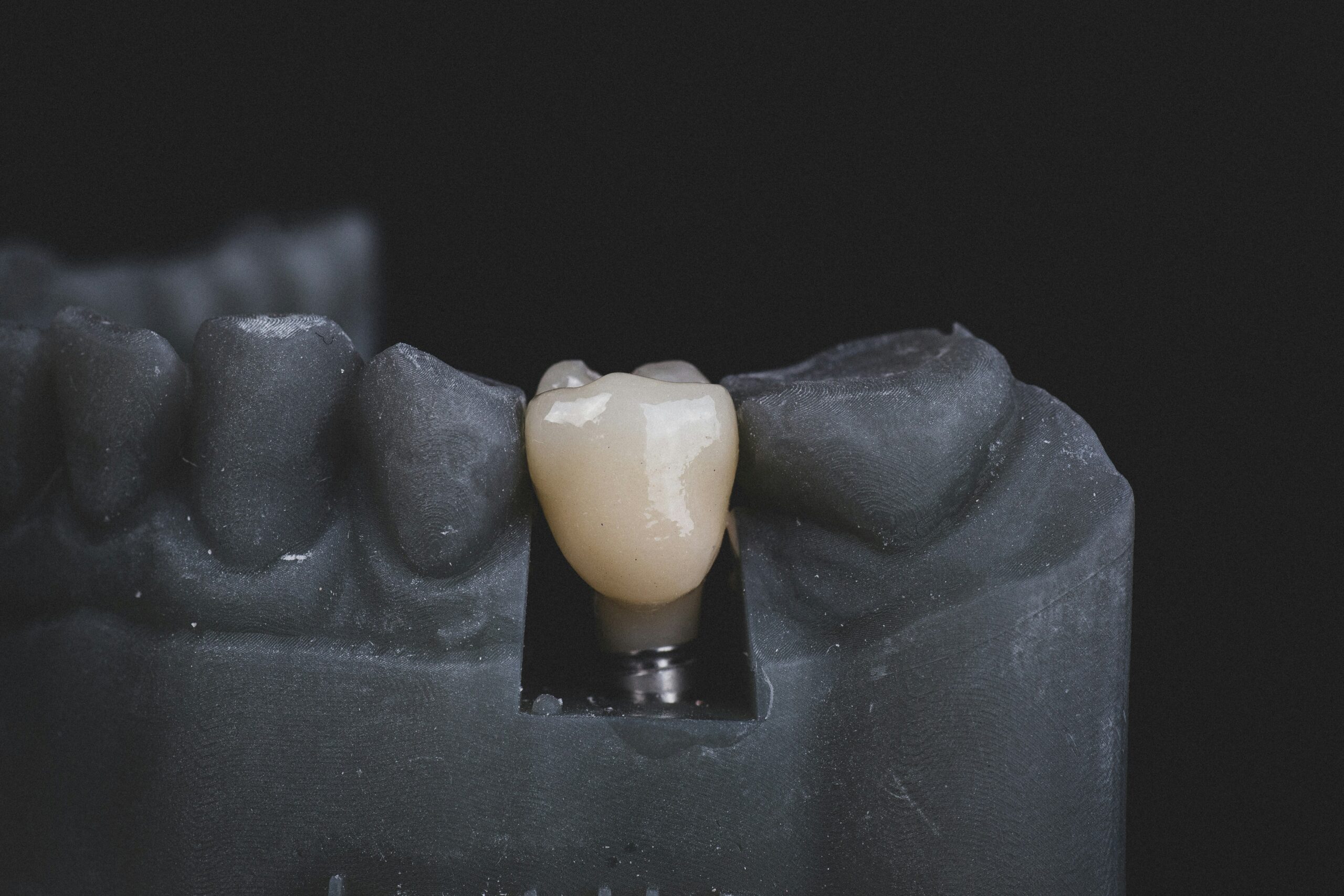 Understanding Dental Implants: Costs and Advantages of Getting Implants in Thailand