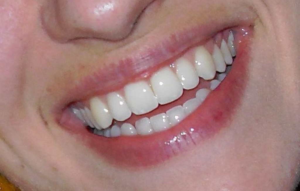 All-on-4 dental implants full arch smile result