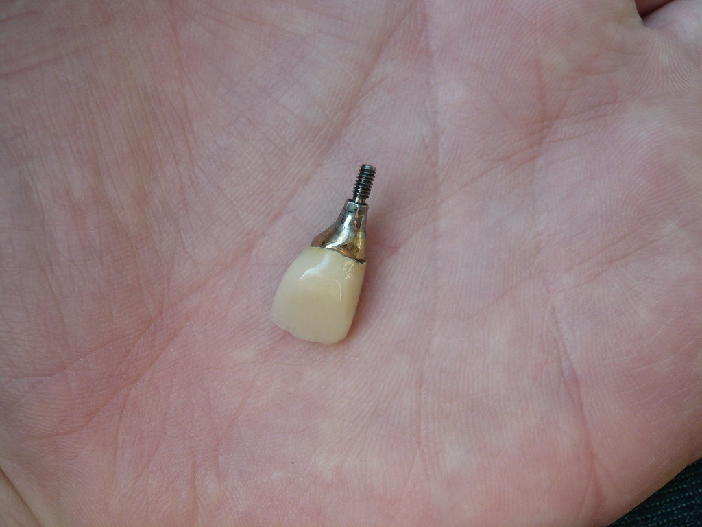 Neobiotech dental implant tooth structure close-up