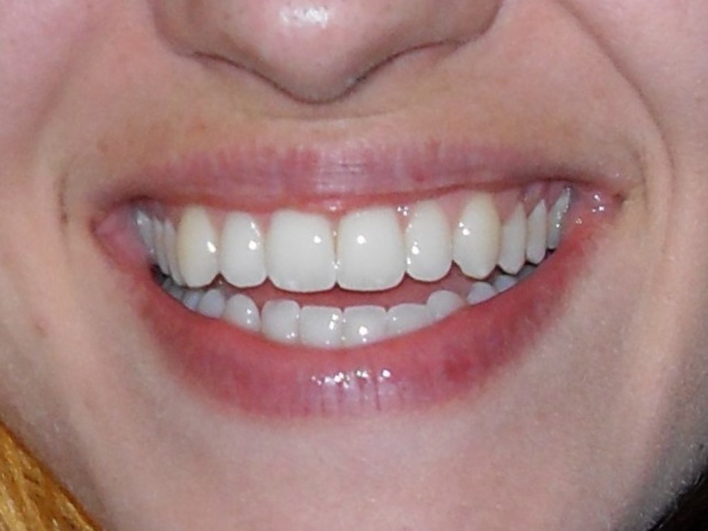 Patient showing healthy teeth after dental implant treatment